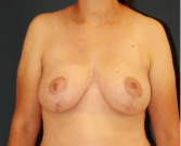 Feel Beautiful - Breast Lift 311 - After Photo